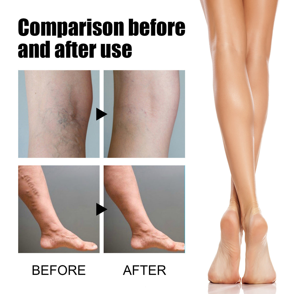 Venolight™ Vein Support Spray | Visibly smoother legs in just 14 days!