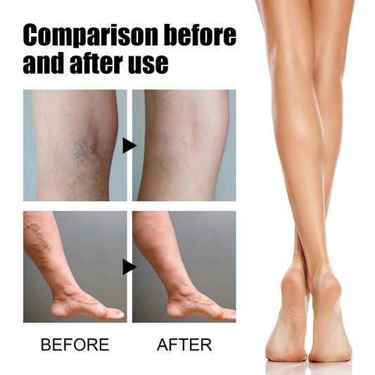 Venolight™ Vein Support Spray | Visibly smoother legs in just 14 days!